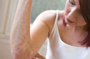 Kontakt Dermatitin Nedenleri, Belirtileri ve Tedavisi