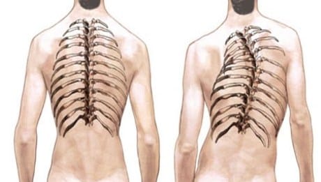 Ankilozan Spondilit Nedir? Nedenleri, Belirtileri ve Tedavisi