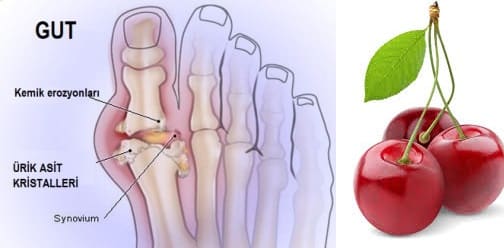 Gut Hastalığı Nedir? Belirtileri, Nedenleri, Tanı ve Tedavi