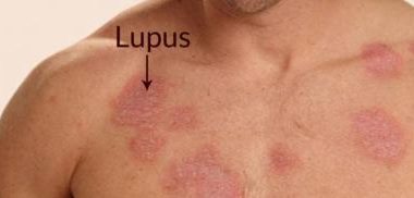 Lupus Hastalığı Nedir? Nedenleri, Tanı ve Tedavisi