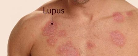Lupus Hastalığı Nedir? Nedenleri, Tanı ve Tedavisi